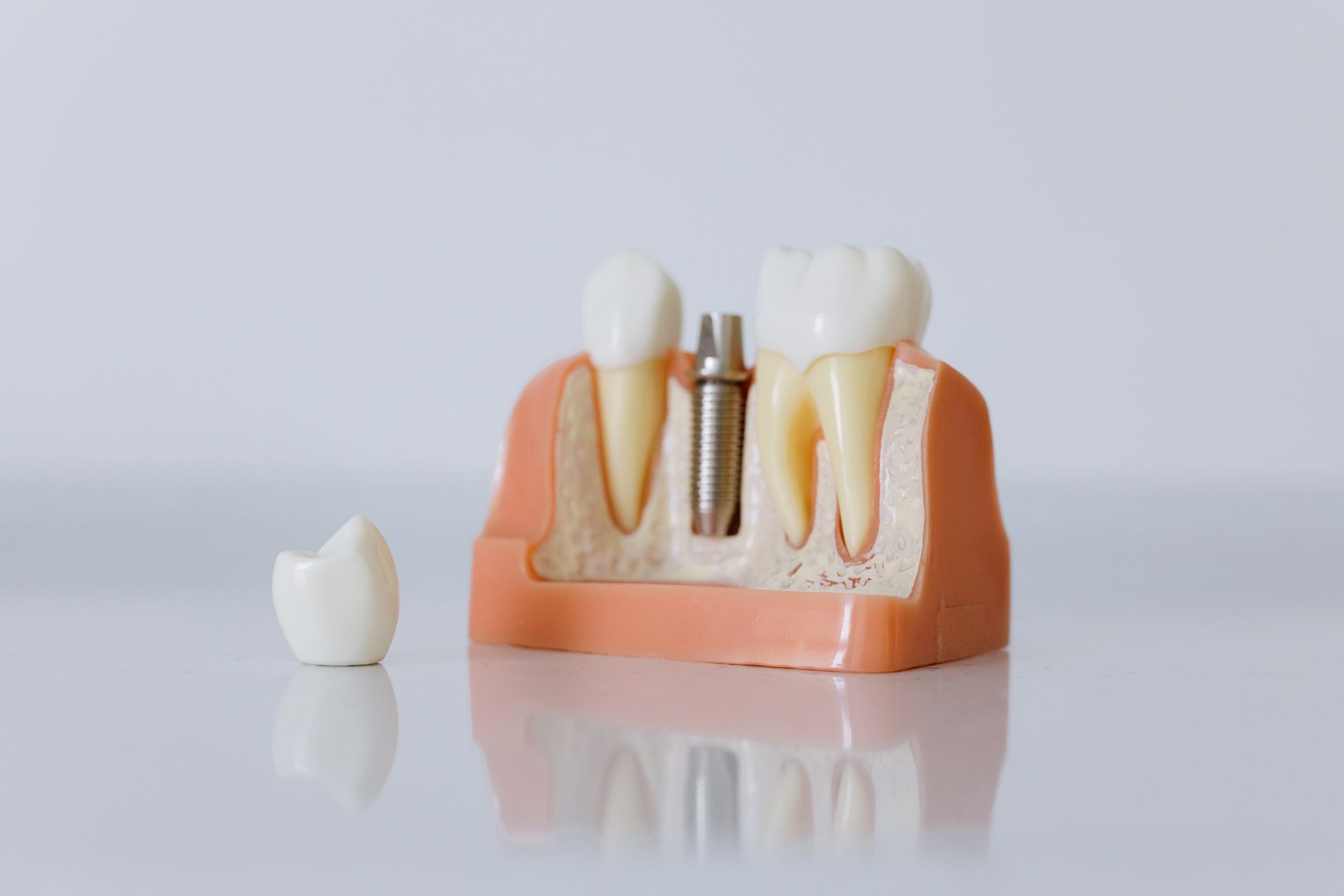Politique de garantie pour les facettes en zircone et les implants en Turquie