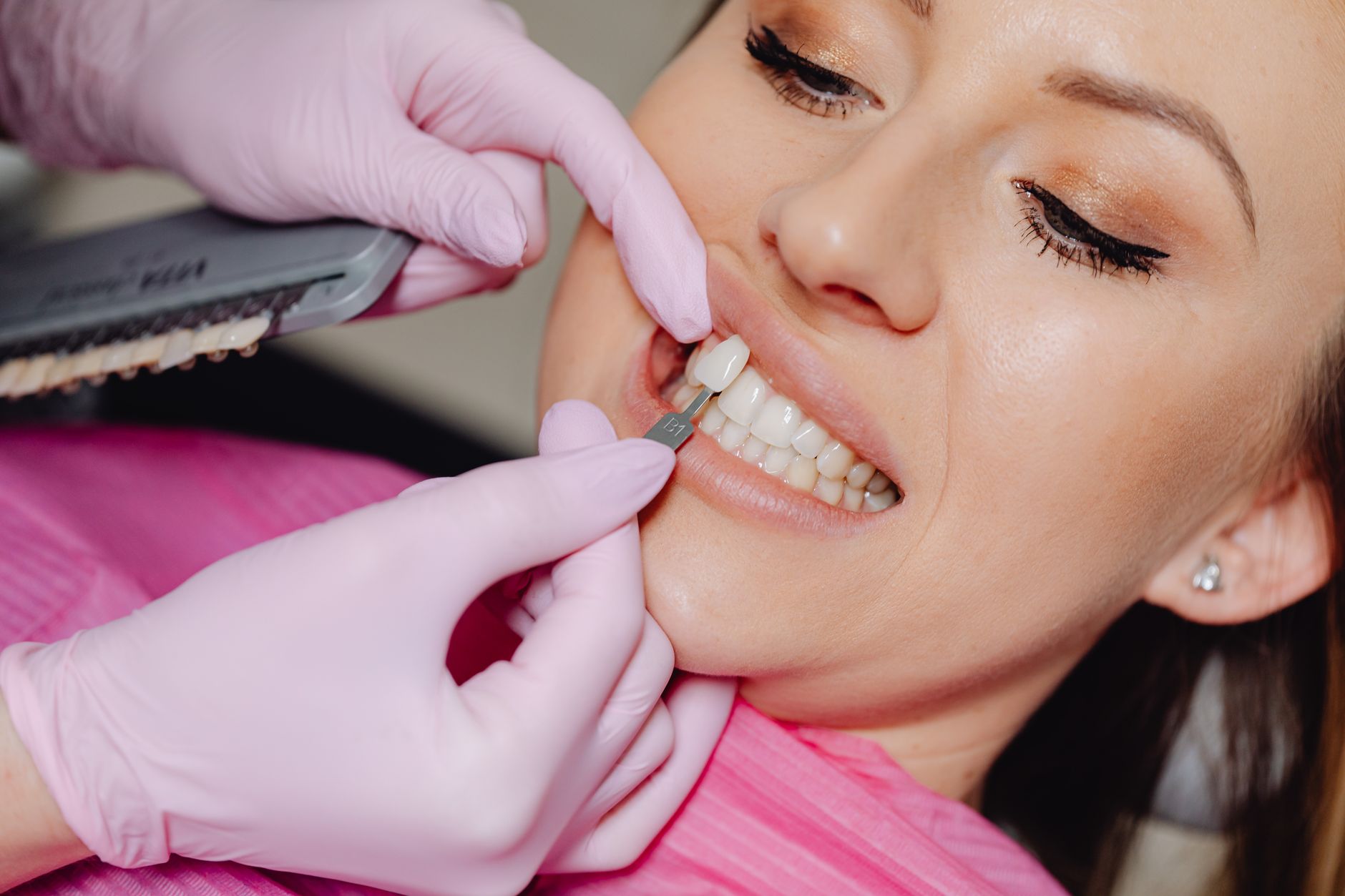 Do Zirconia Veneers Turn Yellow or Darken Over Time?