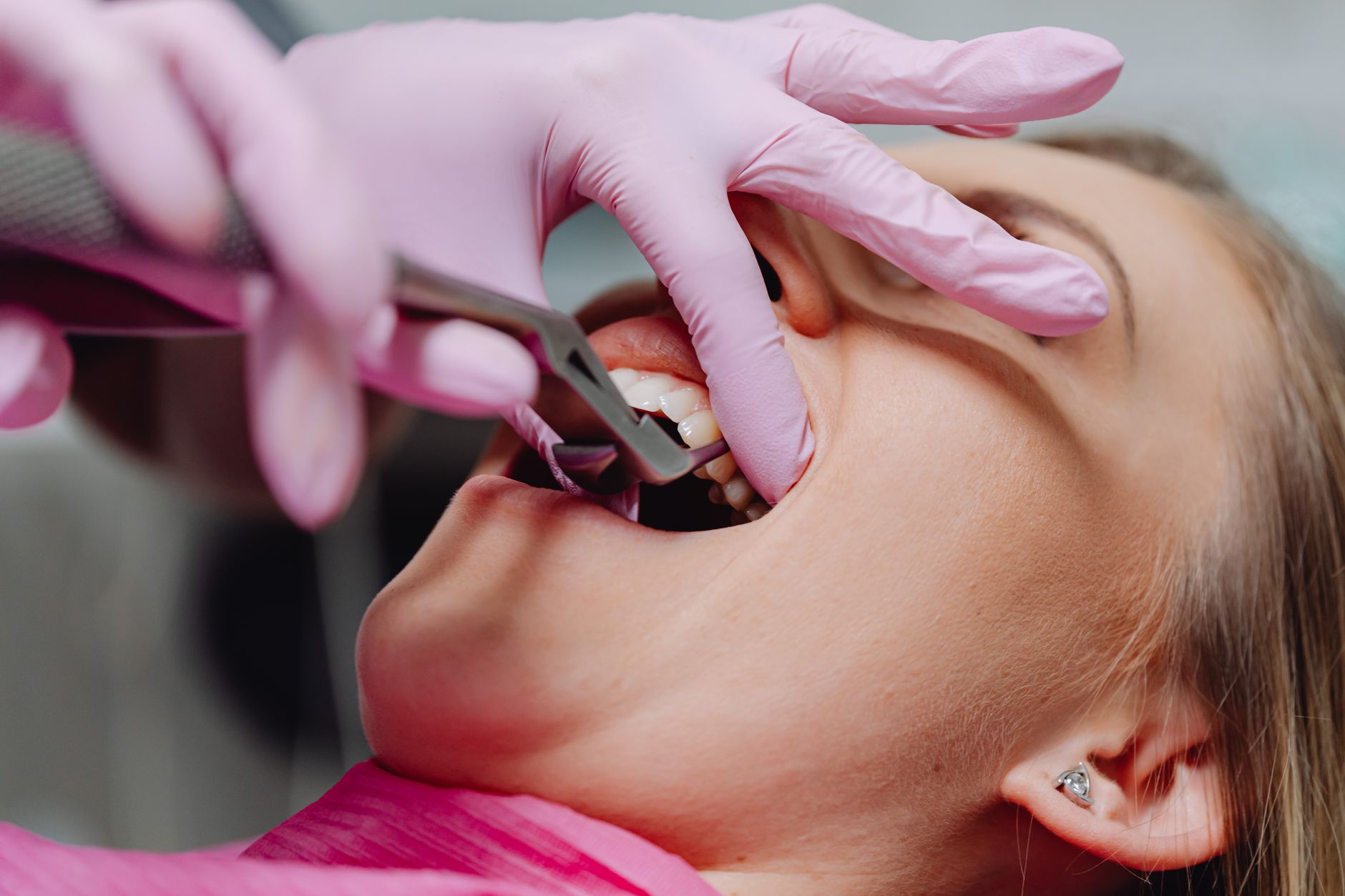 L’extraction dentaire et l’implant le jour même conviennent-elles à tout le monde ?