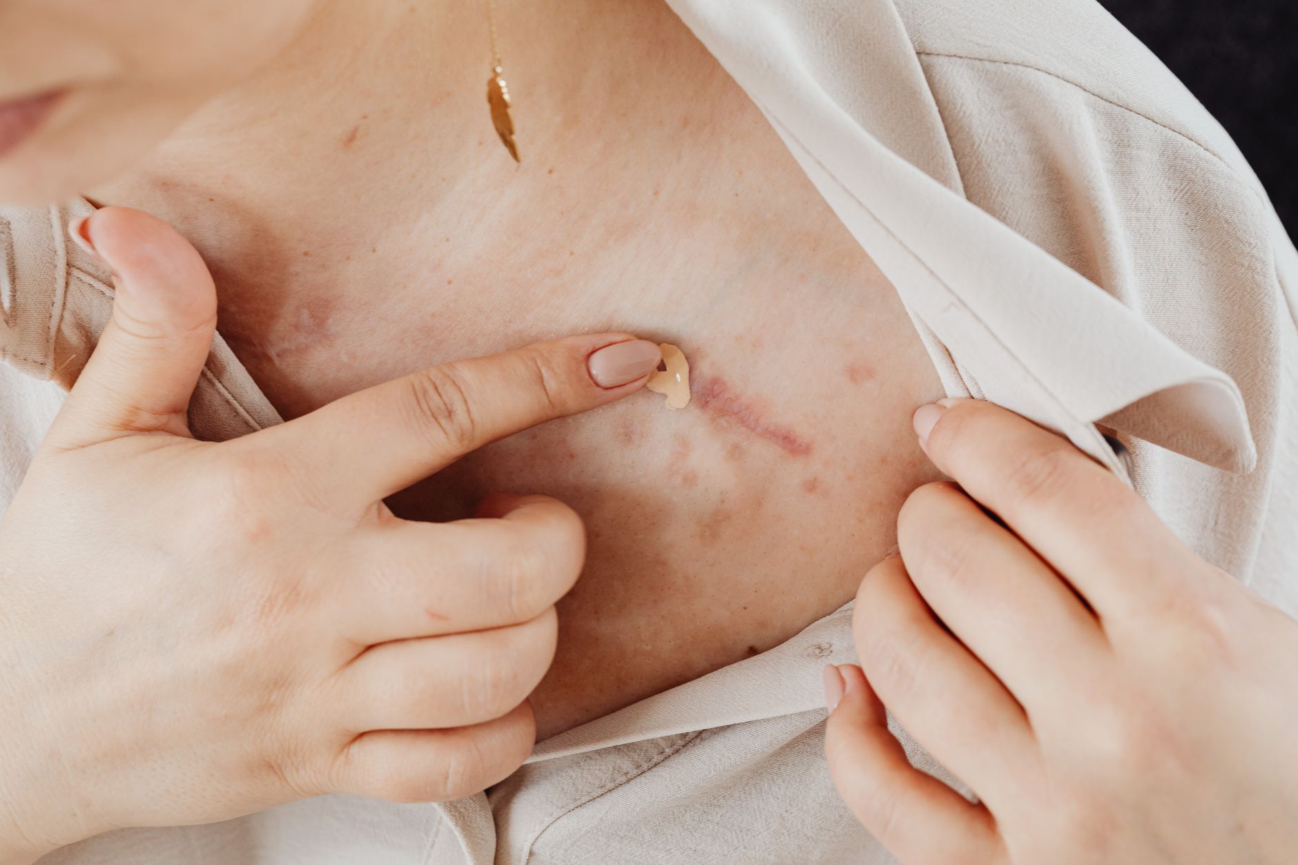 Risques d’infection et de nécrose après une chirurgie esthétique