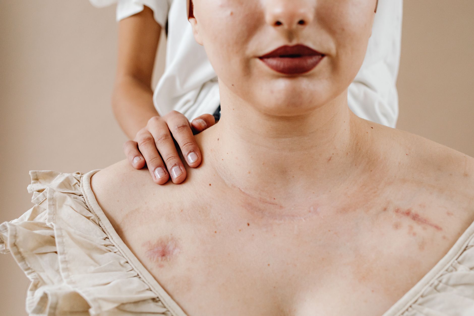Will There Be Scars After Breast Reduction?