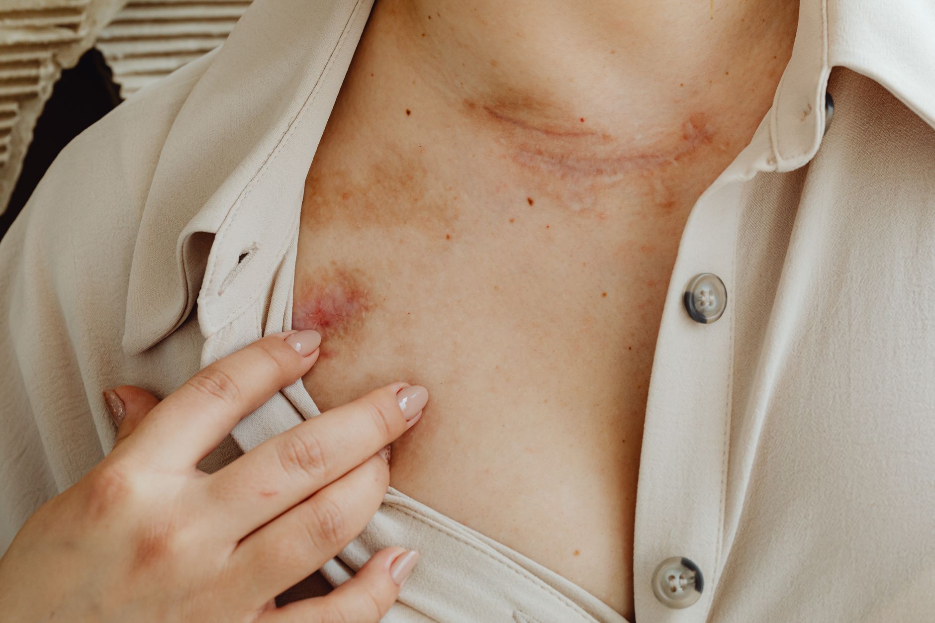 Advanced Burn Scar and Contracture Treatment in Turkey
