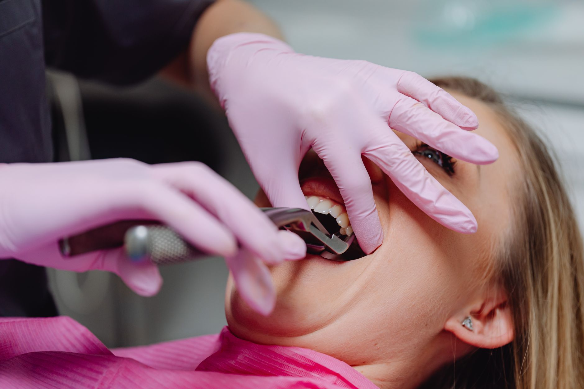 Impacted Wisdom Tooth Extraction with Sedation | Turkey
